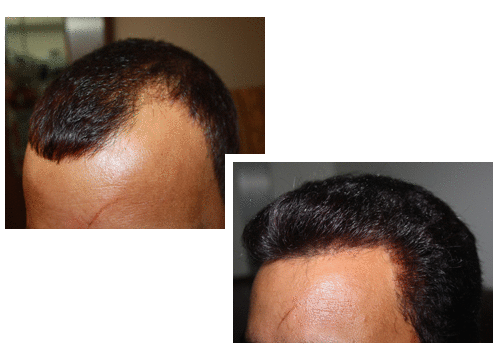 how to regrow hair on lower legs